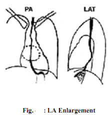 394_Explain Left Atrial Enlargement.png